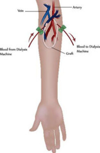 arteriovenoznyj-shunt