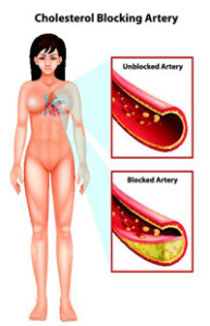 coronary-angioplasty200