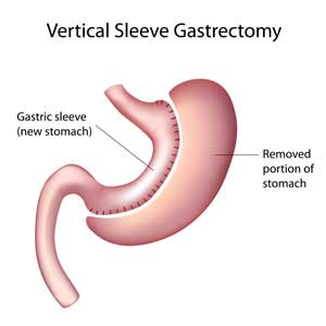 rukavnaia-gastroplastika300-300